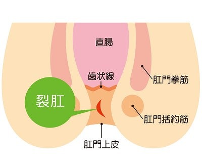 切れ痔（裂孔）とは