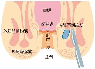 裂肛切除術、肛門ポリープ切除