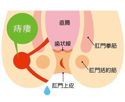 痔ろう（穴痔）とは