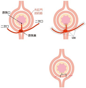 切開開放術