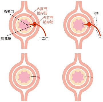 肛門括約筋温存術