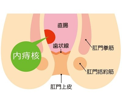 内痔核