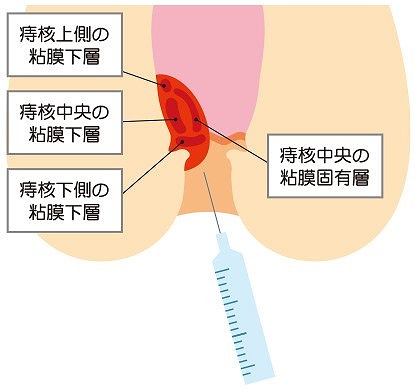 ジオン注射の治療方法（四段階注射法）