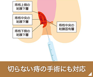 切らない痔の手術にも対応